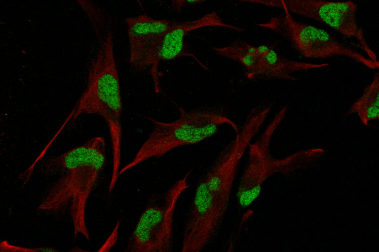 How curiosity uncovered a special trap that steroids set for glioblastoma - Cancer Research UK