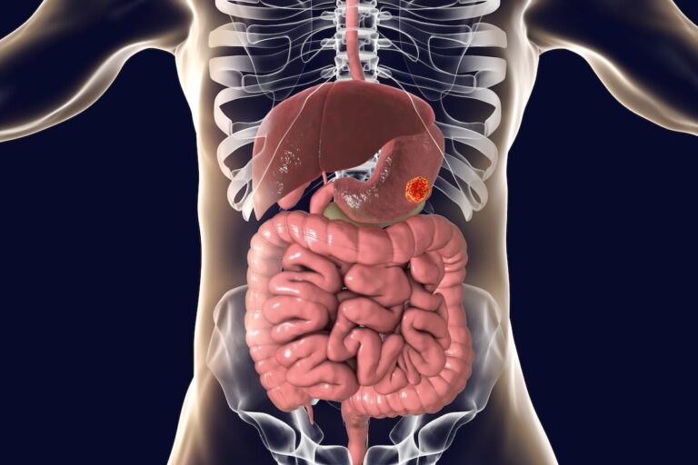 3 Things You Should Know About the Evolving Therapeutic Landscape of GEA