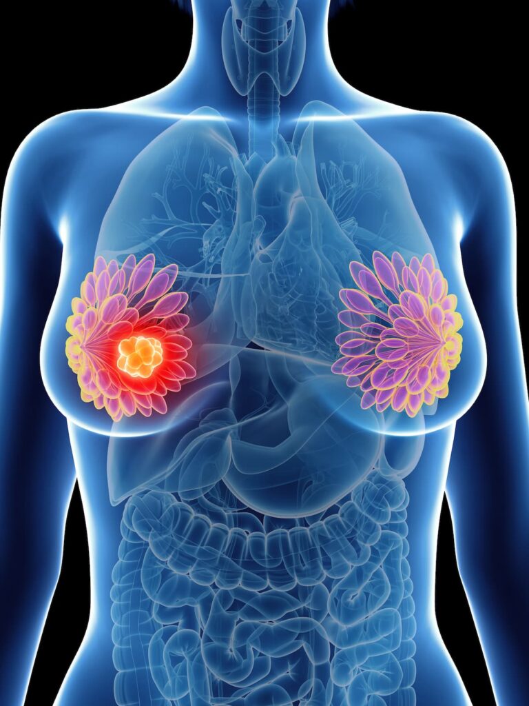 Anbenitamab Injection Combo Meets pCR End Point in HER2+ Breast Cancer Addressing Unmet Needs in HER2+ Metastatic BTC