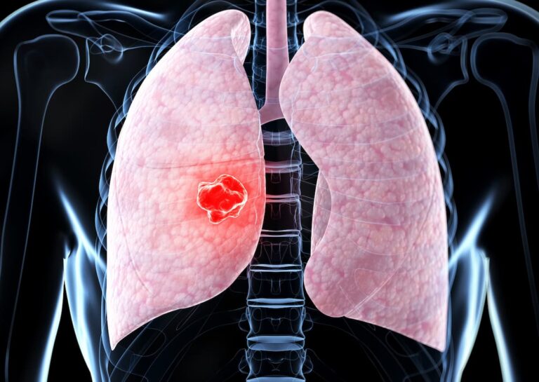 Addressing Unmet Needs in HER2+ Metastatic BTC