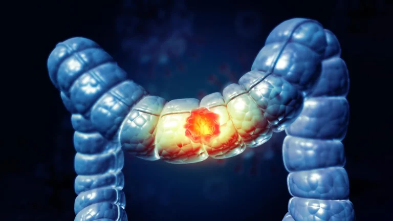 Colon cancer is rising in young adults and doctors don’t fully know why Colon cancer breakthrough keeps patients cancer-free for nearly 3 years