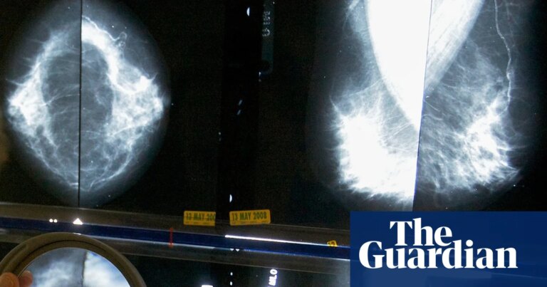 Groundbreaking genomic test could spare millions of breast cancer patients chemotherapy | Breast cancer Groundbreaking genomic test could spare millions of breast cancer patients chemotherapy | Breast cancer