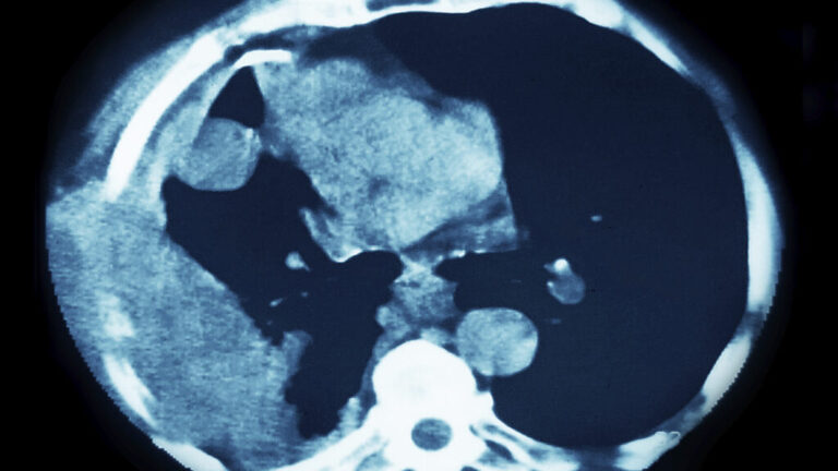 Lung cancer drug from Akeso in China extends survival in study Lung cancer drug from Akeso in China extends survival in study