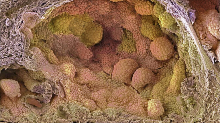 New hormone protocol cut relapse risk in prostate cancer trial New hormone protocol cut relapse risk in prostate cancer trial