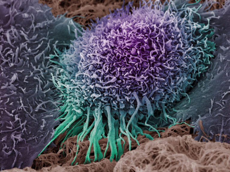 New study looks for better ways to prevent skin cancer in the people most at risk – Cancer Research UK New study looks for better ways to prevent skin cancer in the people most at risk - Cancer Research UK