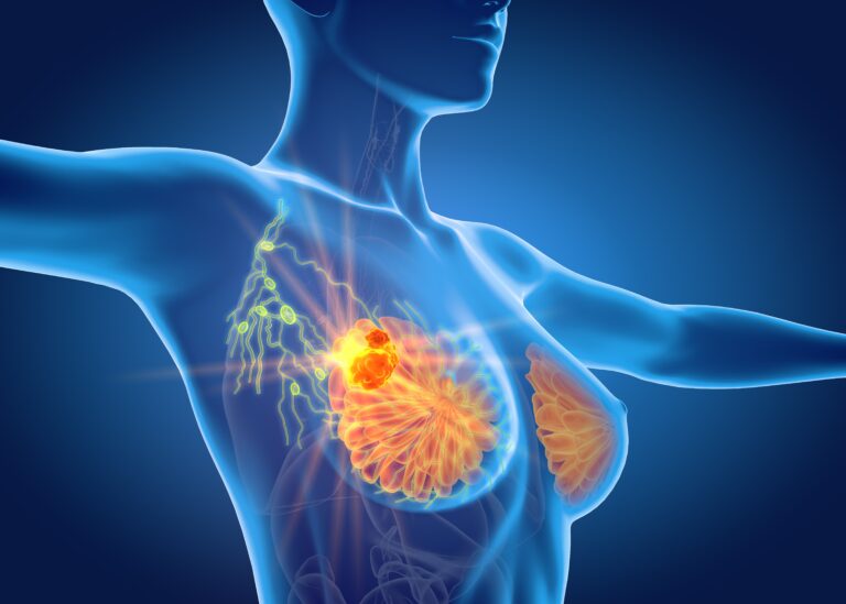SLN Surgery Omission Does Not Increase Radiotherapy Use in Breast Cancer Scout AI