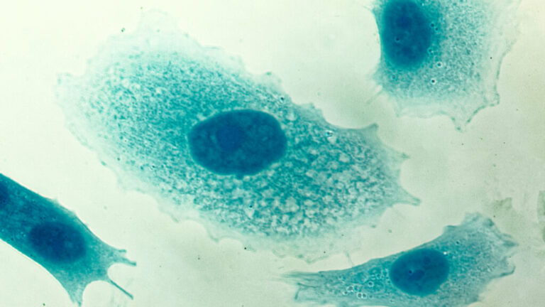 Study: PSA tests likely reduces risk of death from prostate cancer