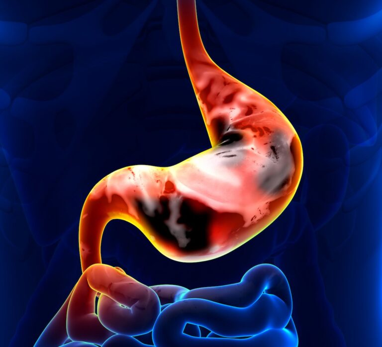 T-DXd 5.4 mg/kg Combos Yield Fewer Grade ≥3 AEs in HER2+ Gastric Cancers Results from the phase 3 SUCCESSOR-2 trial showed MeziKd reduced the risk of progression or death by 52% vs Kd in anti–CD38- and LEN-exposed RRMM.