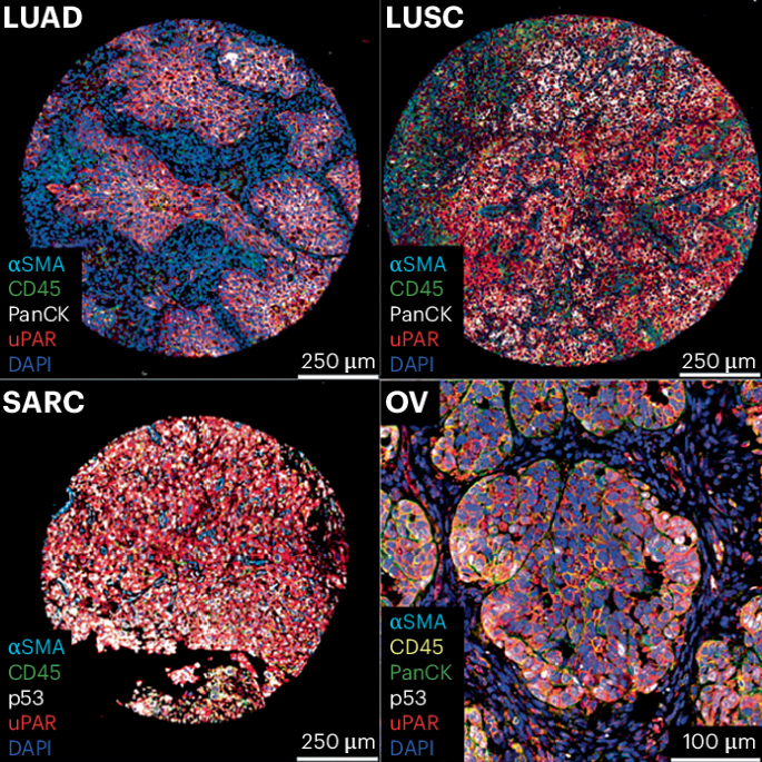 Targeting fibrosis for cancer therapy Targeting fibrosis for cancer therapy