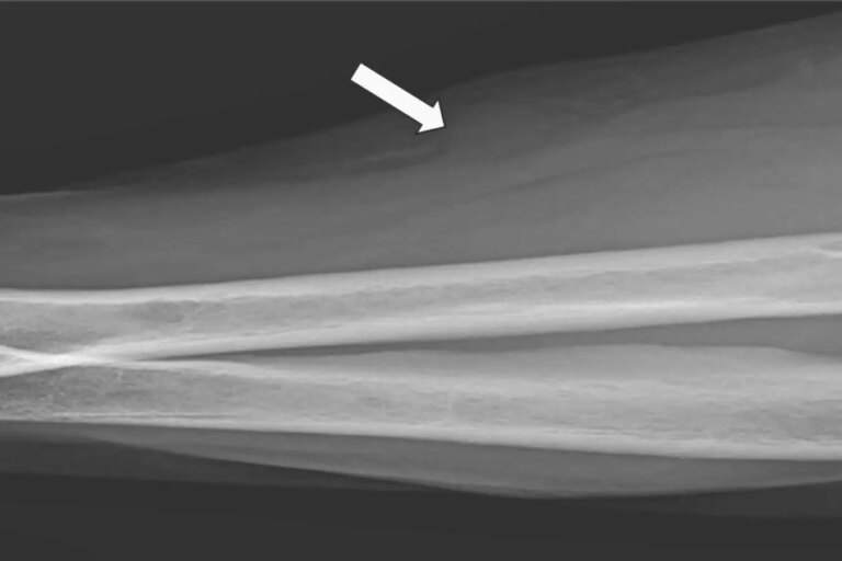Woman in cancer remission without treatment in highly unusual case An X-ray of the woman