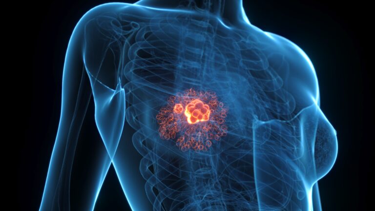 3 Things You Should Know About Using Selective Estrogen Receptor Degraders in Hormone Receptor–Positive, HER2-Negative Advanced Breast Cancer 3 Things You Should Know About Using Selective Estrogen Receptor Degraders in Hormone Receptor–Positive, HER2-Negative Advanced Breast Cancer