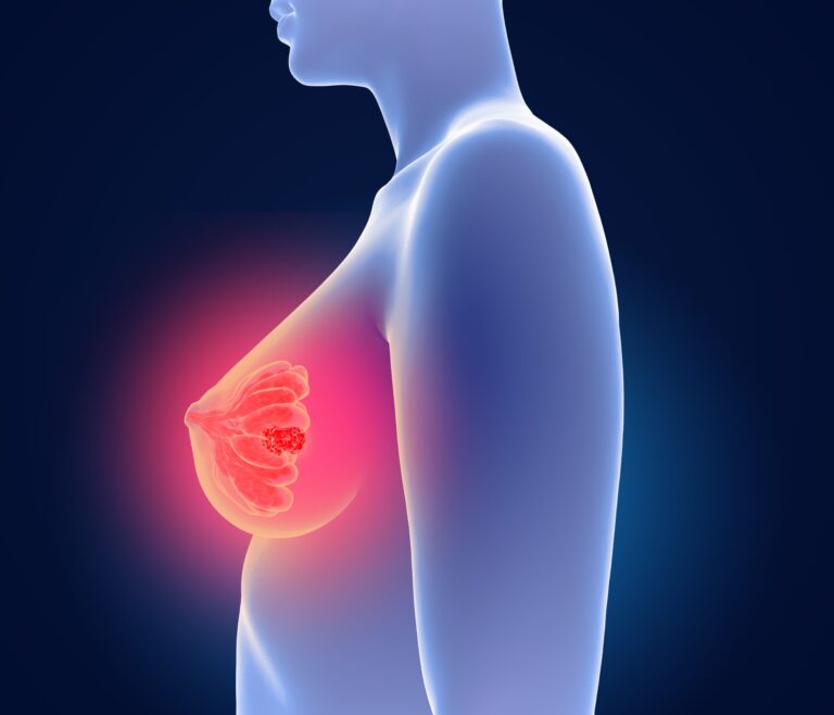 Anbenitamab Regimen Meets Phase 3 End Points in HER2+ Breast Cancer Experts discuss how updated findings from the TALAPRO-3 and PROTEUS trials may impact the prostate cancer paradigm.
