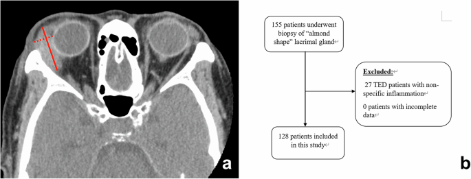 Biopsied lacrimal glands in Japanese cohort: clinical, radiologic and histopathologic analysis Biopsied lacrimal glands in Japanese cohort: clinical, radiologic and histopathologic analysis