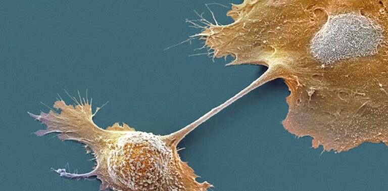 Breakthrough drug nearly doubles survival with advanced pancreatic cancer – an oncologist explains how daraxonrasib overcame an ‘undruggable’ disease
