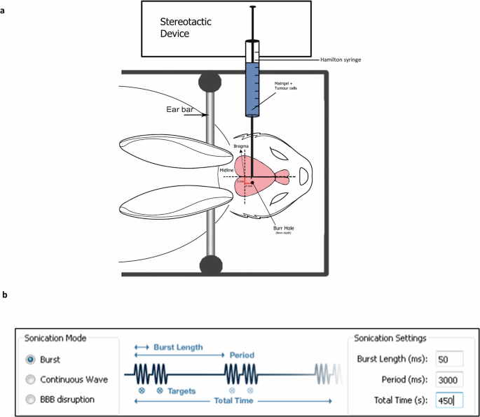 Evaluation of CNS xenograft brain tumour response to MRI-guided focused ultrasound in combination with radiation therapy Evaluation of CNS xenograft brain tumour response to MRI-guided focused ultrasound in combination with radiation therapy