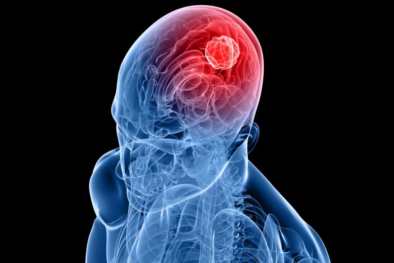 Phase 1 data support arlo-cel as a potentially effective early-line treatment option for those with relapsed/refractory multiple myeloma.