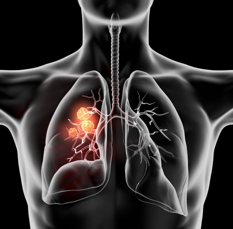 FLAME: Osimertinib Plus Chemotherapy Improves PFS in ctDNA-Persistent NSCLC The role of adjuvant immunotherapy remains unclear in this NSCLC population following data from the phase 3 ALCHEMIST trial.