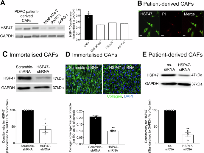 HSP47 is a potential dual cell target and prognostic factor in pancreatic cancer HSP47 is a potential dual cell target and prognostic factor in pancreatic cancer