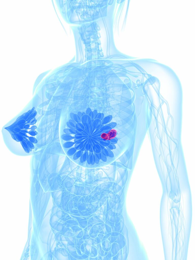 Izalontamab Brengitecan Improves OS/PFS in Advanced/Metastatic TNBC More than 90% of patients achieved a composite complete response to azacitidine plus venetoclax and ivosidenib in a phase 1b/2 trial.