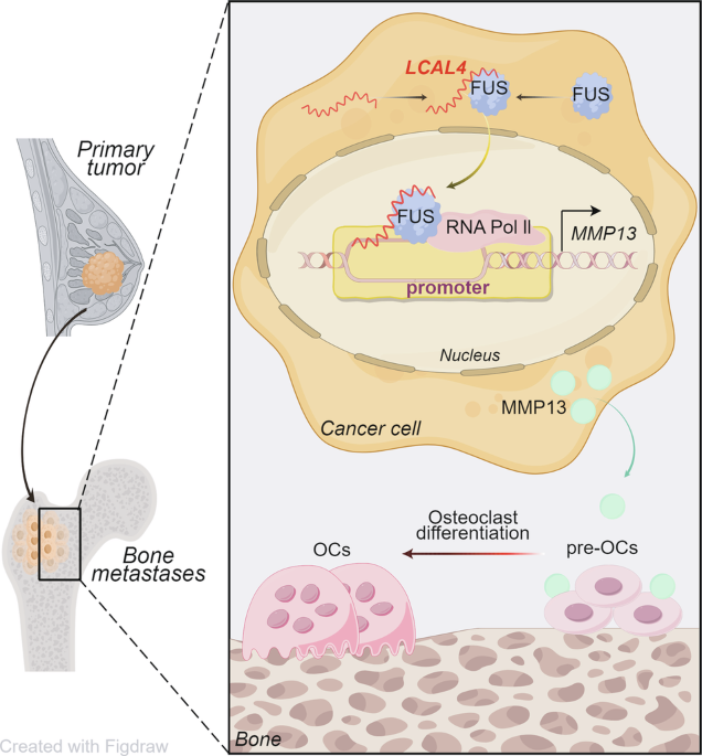 LCAL4–FUS cooperation switches on MMP13 and drives osteolytic bone metastasis in breast cancer LCAL4–FUS cooperation switches on MMP13 and drives osteolytic bone metastasis in breast cancer