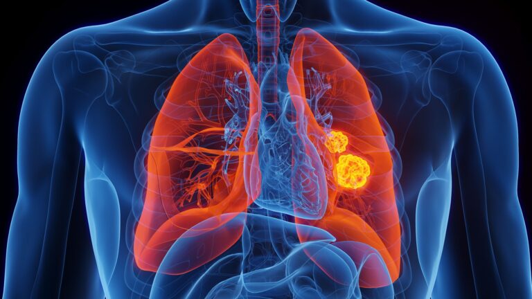 Lurbinectedin Misses Survival End Point in Second-Line SCLC Trial