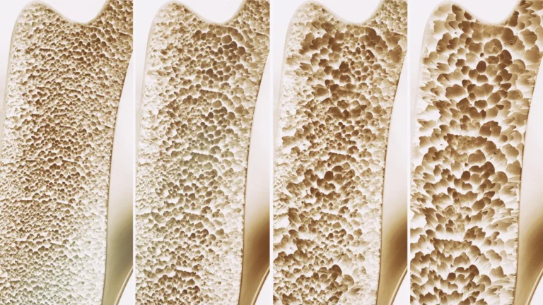 Millions take calcium and vitamin D for stronger bones. A major review finds little benefit Millions take calcium and vitamin D for stronger bones. A major review finds little benefit