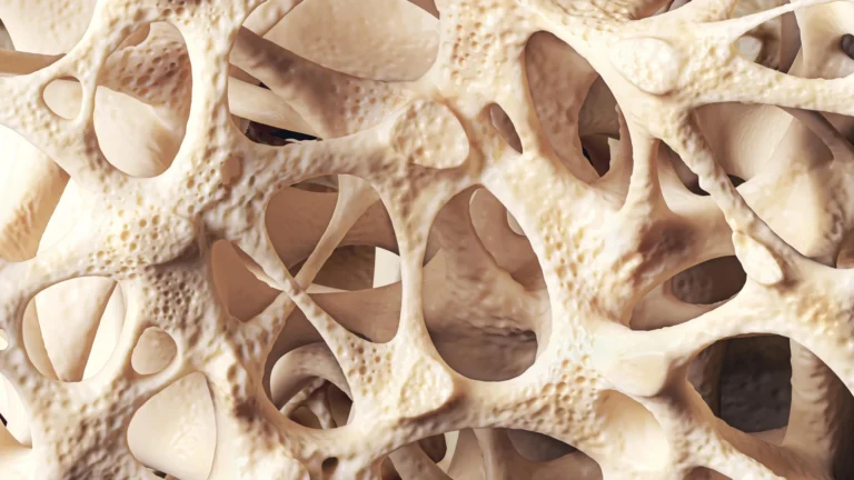 Osteopenia is silently weakening bones in millions of people