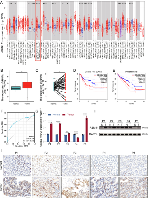 RNA binding motif protein RBM41 promotes colorectal tumorigenesis by impeding the maturation of NDRG1 pre-mRNA RNA binding motif protein RBM41 promotes colorectal tumorigenesis by impeding the maturation of NDRG1 pre-mRNA