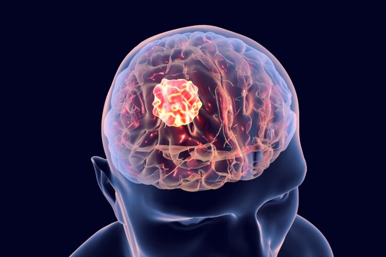 TRIDENT Trial Finds No Survival Benefit With Earlier Tumor Treating Fields Use Lymphoma