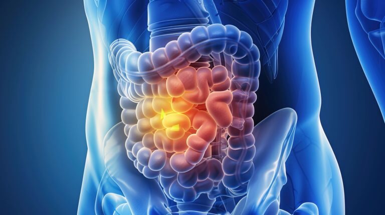 Bladder Cancer