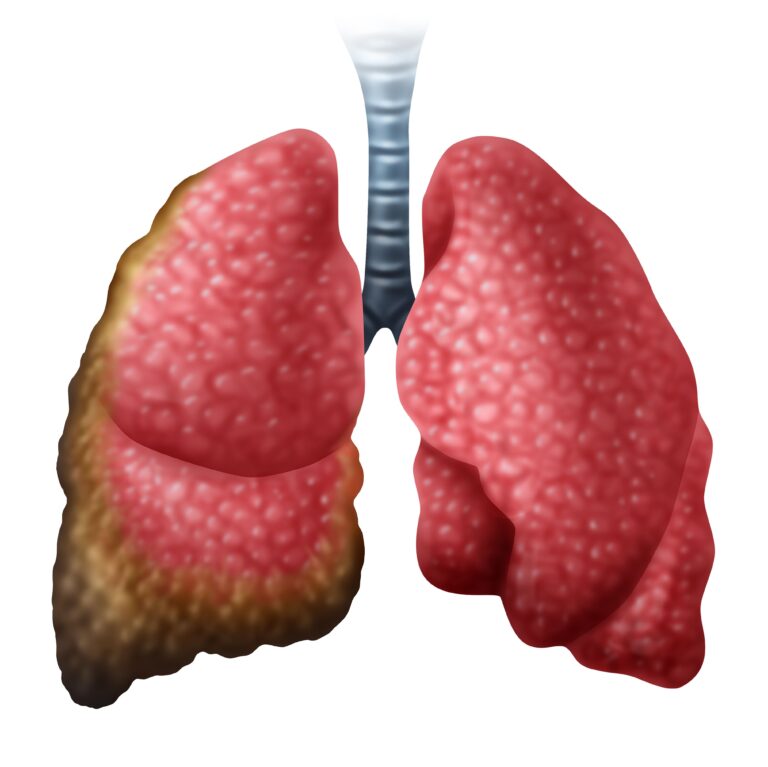 AI-Based Pan-TEAD Inhibitor Wins FDA Fast Track Designation in Mesothelioma Human Urinary System Kidneys with Bladder Anatomy