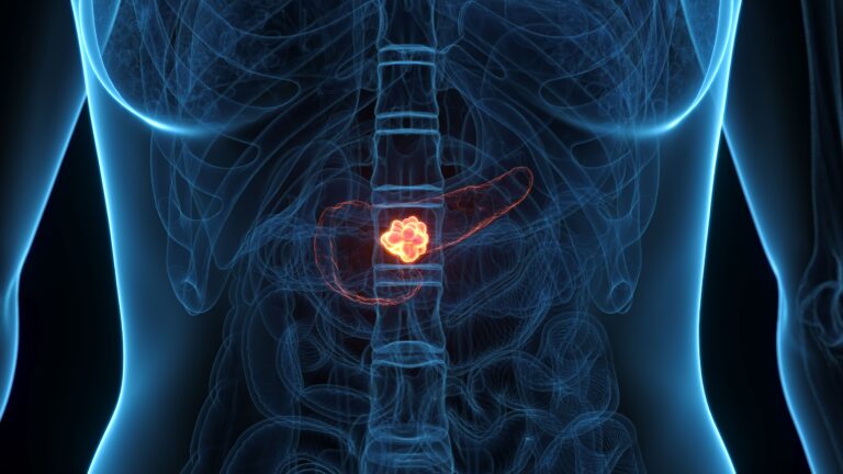 EMA’s Review of Daraxonrasib in PDAC Accelerated Under Phased Review Process Education and reinforcement may improve luspatercept dose titration and persistence in community practice.
