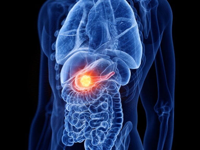 3d rendered medically accurate illustration of prostate cancer