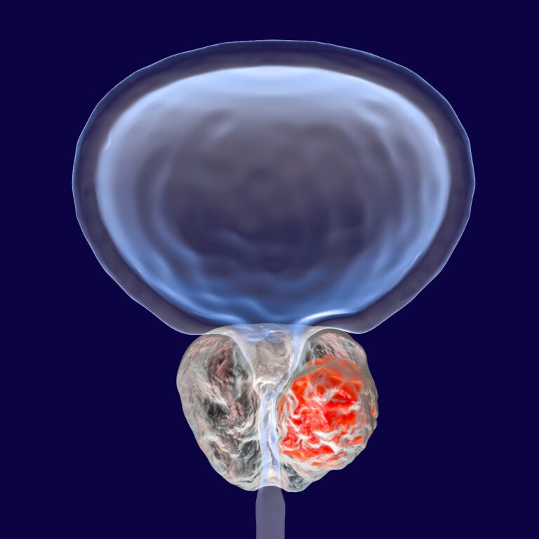 Focal HIFU/Cryotherapy Show Durable 10-Year Control in Prostate Cancer Focal HIFU/Cryotherapy Show Durable 10-Year Control in Prostate Cancer