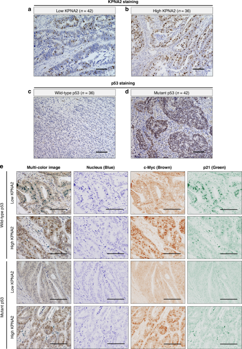 High KPNA2 expression predicts poor prognosis in pathological T4 colorectal cancer by importing c-Myc into the nucleus to suppress p53-dependent p21 expression High KPNA2 expression predicts poor prognosis in pathological T4 colorectal cancer by importing c-Myc into the nucleus to suppress p53-dependent p21 expression