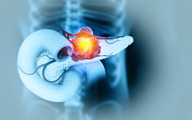 Namodenoson Yields Durable Survival Outcomes in Pretreated Pancreatic Cancer Namodenoson Yields Durable Survival Outcomes in Pretreated Pancreatic Cancer