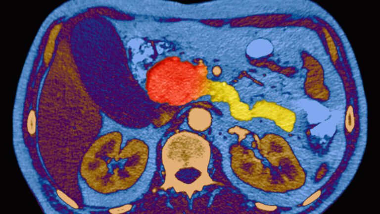Pancreatic cancer experts gather to discuss what comes after daraxonrasib