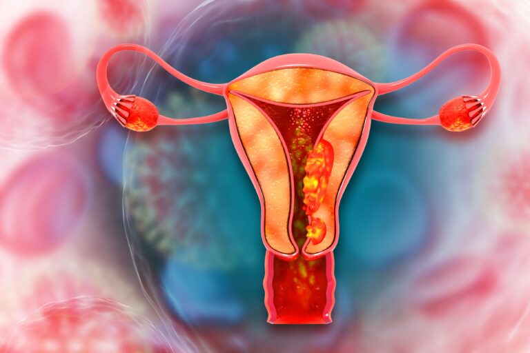 Pembrolizumab Monotherapy Improves PFS in Frontline dMMR Endometrial Cancer Female breast cancer, Breast anatomy with cancer cells. 3d illustration: © Rasi - stock.adobe.com