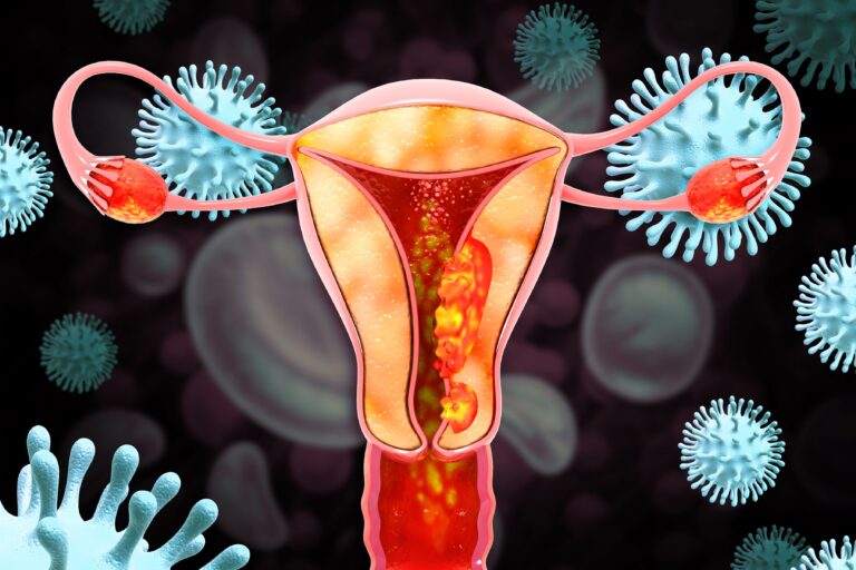 Selinexor Misses PFS End Point in TP53 Wild-Type Endometrial Cancer