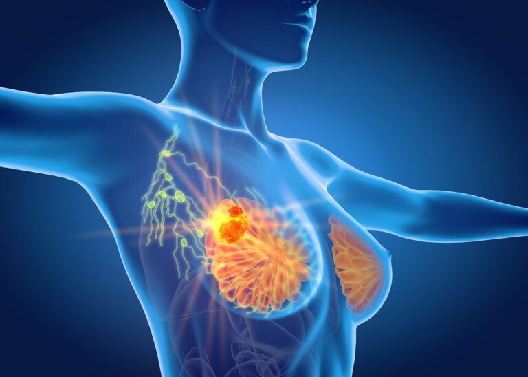 ADCs in the Frontline: Evolving Approaches in Metastatic TNBC Imetelstat may be considered as a frontline option for patients with a high transfusion burden, said Amer Zeidan, MBBS, MD.