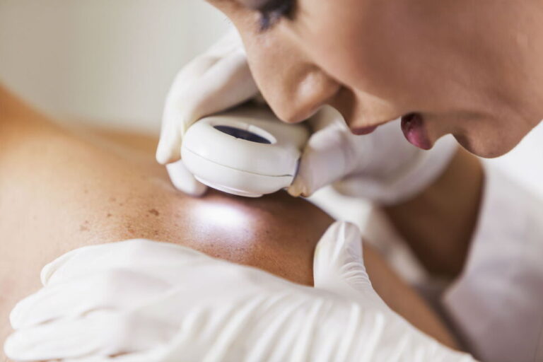 Skin Cancer: Symptoms, Causes and Treatment