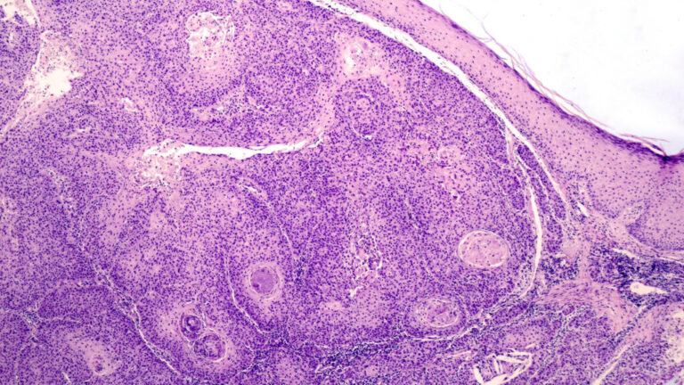 Tracking FDA expert review of Replimune’s melanoma treatment