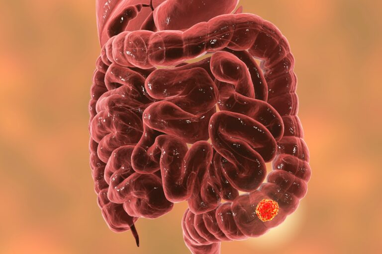 Botensilimab/Balstilimab Elicits Major Pathologic Responses in Colon Cancer Botensilimab/Balstilimab Elicits Major Pathologic Responses in Colon Cancer