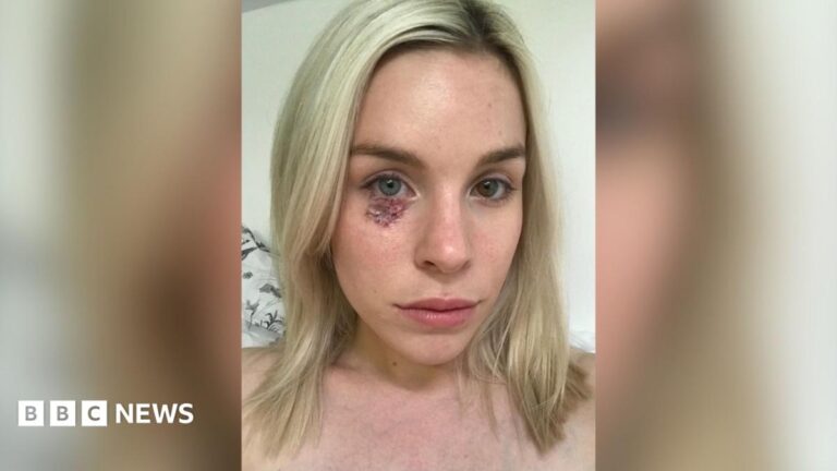 A young woman with shoulder length blonde hair with a red scar and scar tissue under her right eyelid.