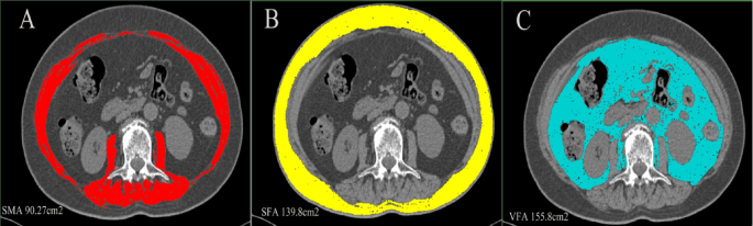 Effect of preoperative body composition on long-term outcomes in patients undergoing distal cholangiocarcinoma resection Effect of preoperative body composition on long-term outcomes in patients undergoing distal cholangiocarcinoma resection