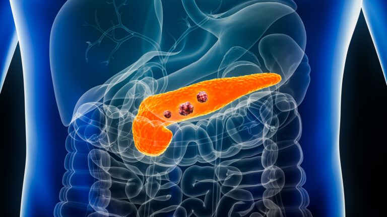 Olomorasib Earns FDA Breakthrough Therapy in KRAS G12C+ Pancreatic Cancer Olomorasib Earns FDA Breakthrough Therapy in KRAS G12C+ Pancreatic Cancer