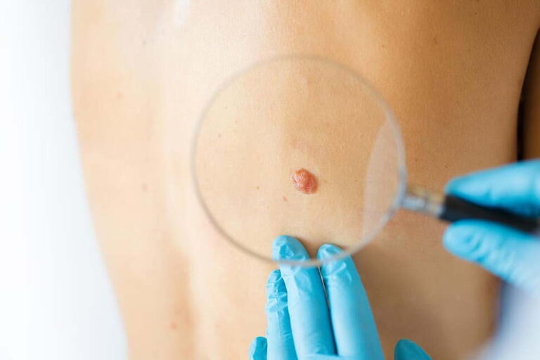 Personalized Vaccine Helped Melanoma Patients Stay Cancer-Free Longer, Drugmakers Say Personalized Vaccine Helped Melanoma Patients Stay Cancer-Free Longer, Drugmakers Say