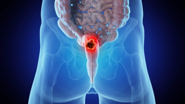 Data from the phase 3 EXCALIBER-RRMM trial support the FDA approval of iberdomide plus daratumumab and dexamethasone in this multiple myeloma population.