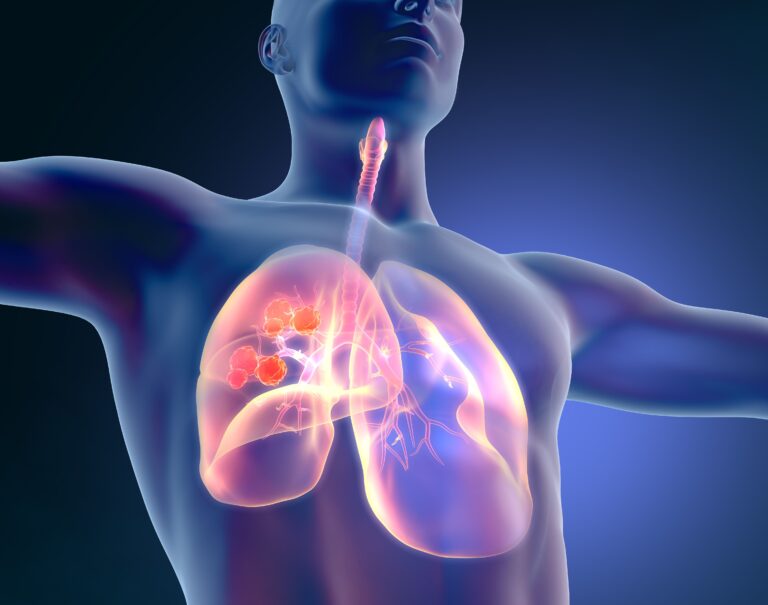 Hans Lee, MD, said it is only a matter of time before bispecific antibodies move into the newly diagnosed multiple myeloma setting.