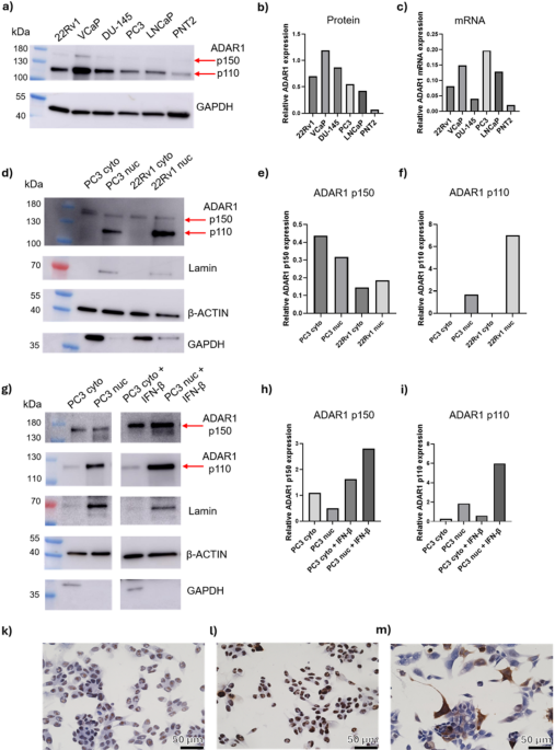 ADAR1 is increased in prostate cancer progression and silencing reduces A-to-I editing and cell growth while enhancing apoptosis and adhesion ADAR1 is increased in prostate cancer progression and silencing reduces A-to-I editing and cell growth while enhancing apoptosis and adhesion